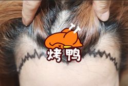 -大麦微针植发全国连锁