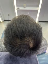 体验后-大麦微针植发全国连锁