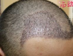 -大麦微针植发丨全国连锁