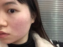 点击看大图 体验后-南京康美美容医院·旗舰店