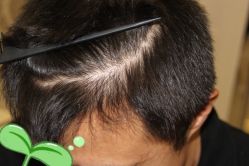 -大麦微针植发丨全国连锁