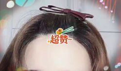 -大麦微针植发全国连锁