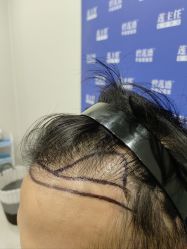 -碧莲盛·不剃发植发