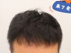 -大麦微针植发全国连锁