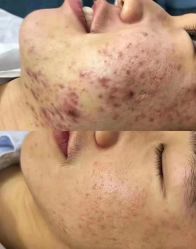 -苗方清颜专业祛痘连锁机构