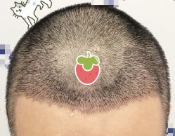 -大麦微针植发全国连锁