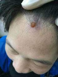 -痣斑堂·取大痣