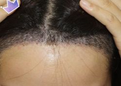 -大麦微针植发丨全国连锁