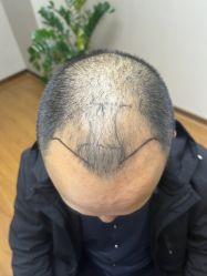 体验前-大麦微针植发全国连锁