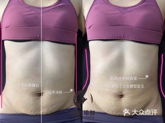 产后内脏下垂： 孕妈妈10月怀胎，一朝分娩