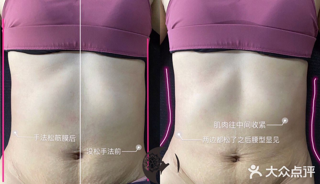 #产后修复