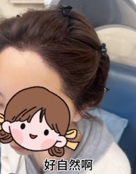 -大麦微针植发丨全国连锁