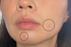 体验后-More摩尔医美の注射线雕光电中心