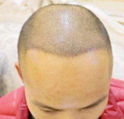 -大麦微针植发全国连锁