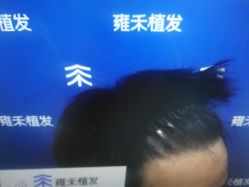 -雍禾植发全国连锁