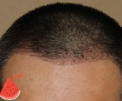 -大麦微针植发丨全国连锁