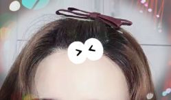 -大麦微针植发全国连锁