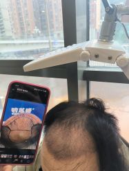 -碧莲盛·不剃发植发