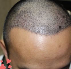 -大麦微针植发丨全国连锁