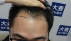 -大麦微针植发丨全国连锁