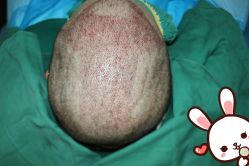 点击看大图 -大麦微针植发丨全国连锁