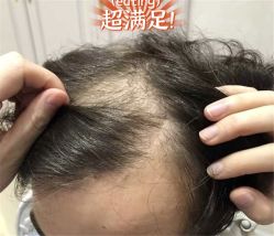 -大麦微针植发全国连锁