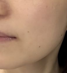 体验后-杭州米兰柏羽医疗美容医院