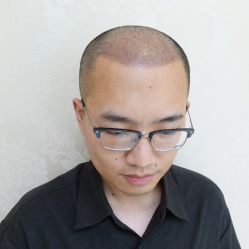-碧莲盛·不剃发植发