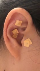 -肥三针腧穴瘦身馆