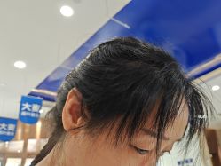 体验后-大麦微针植发全国连锁