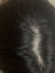 -碧莲盛·不剃发植发