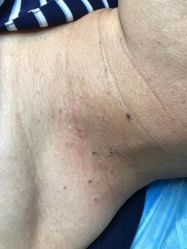-爱莎扁平疣·汗管瘤·斑痣中心