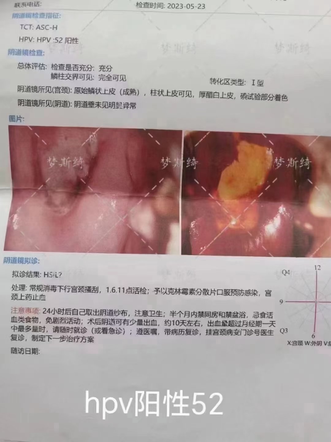 女人感染hpv52图片图片