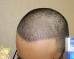 -大麦微针植发丨全国连锁