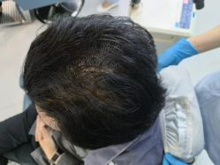 体验后-大麦微针植发全国连锁