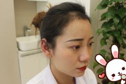 -大麦微针植发丨全国连锁