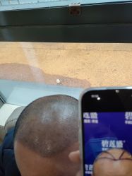 -碧莲盛·不剃发植发