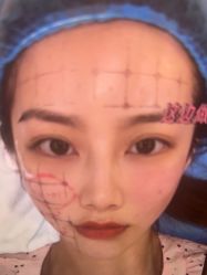 体验后-杭州米兰柏羽医疗美容医院