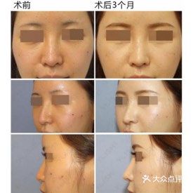 日本整形|关于隆鼻的那些事