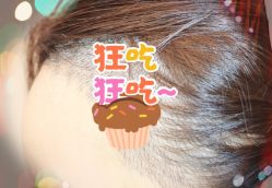 -大麦微针植发全国连锁