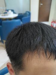 -碧莲盛·不剃发植发