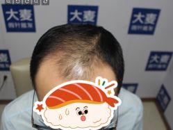 -大麦微针植发丨全国连锁
