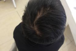 -大麦微针植发丨全国连锁