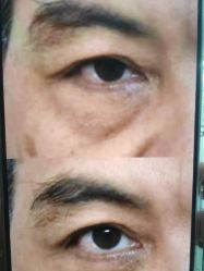 -广州健丽·去眼袋医疗美容机构