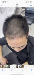 体验后-大麦微针植发丨全国连锁