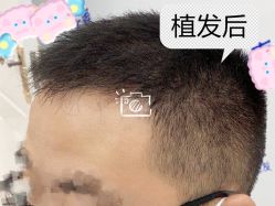 -大麦微针植发全国连锁