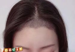 -大麦微针植发丨全国连锁