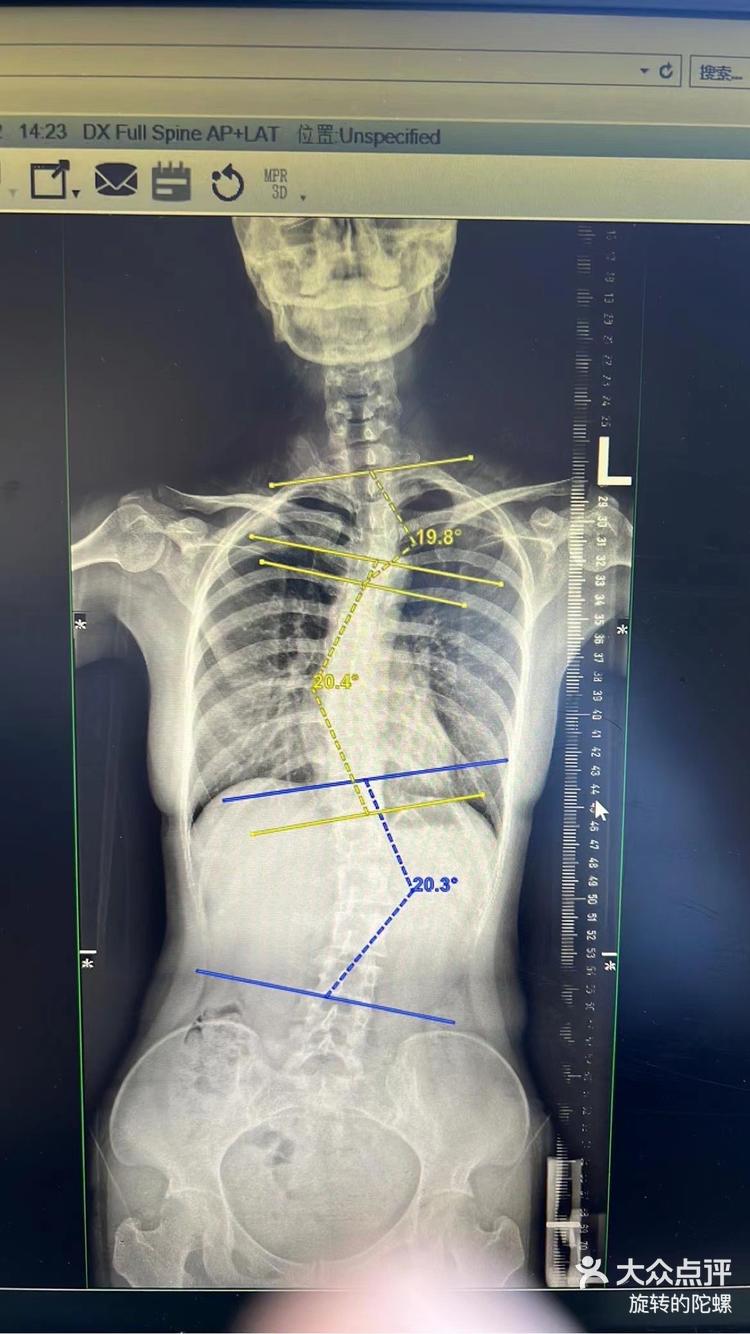 女孩脊柱侧弯10度照片图片