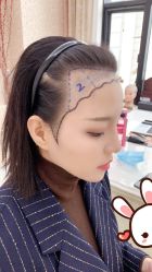 点击看大图 -大麦微针植发丨全国连锁