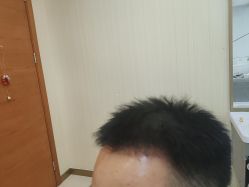 -碧莲盛·不剃发植发